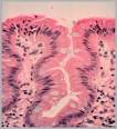 Barrett's Esophagus | ACG Patients