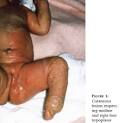 <b>ichthyosiform erythroderma</b> www.gfmer.ch