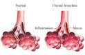 Chronic Bronchitis — UVA Health