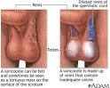 What is a <b>Varicocele</b>?