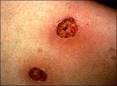 <b>Ectima</b> gangrenoso