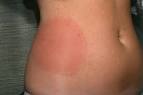 <b>Erythema chronicum migrans</b>