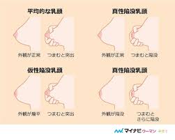 陥没乳頭|横浜市鶴見の形成・美容外科 エムズクリニック