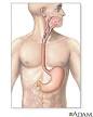 Esophageal cancer