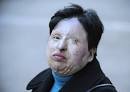 Victims of battery acid attack