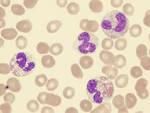 <b>myelodysplastic</b>-<b>syndrome</b>-