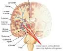 BRAIN CELL DAMAGE FROM AMINO ACID ISOLATES