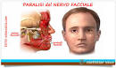 Paralisi del nervo facciale « HarDoctor News, il Blog di Carlo Cottone - paralisi-del-nervo-facciale