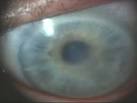 <b>Corneal edema</b>: <b>cornea</b> takes a