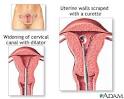 D and C : Medline Plus Medical Encyclopedia Image
