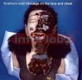 Vitriolage   Sulphuric Acid Burns on Head and Face Vitriolage