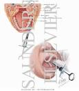 Long Buccal Nerve Block - Netter Medical Images