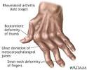 <b>Rheumatoid arthritis</b>