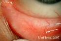 EyeRounds.org: Ocular <b>Sarcoidosis</b>: A systems-based approach to