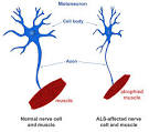 exploringdiseases - ALS (Amyotrophic lateral sclerosis)