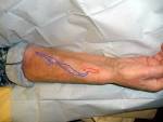 File:Schema fistule arterio-veineuse - AV <b>fistula</b>.jpg - Wikimedia