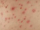 Maculopapular Rash – Definition, Symptoms, Causes, Differential ...