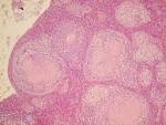 <b>Malattia Da Accumulo Di</b> Acido www.lookfordiagnosis.com