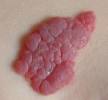 Birthmarks: MedlinePlus