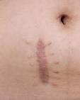 <b>Cicatrix Hypertrophy</b>