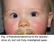 the risk of <b>esotropia</b>?