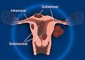 Uterine (<b>Myoma</b>) Fibroids