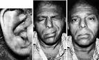 Fig. 5. Ramsay Hunt syndrome.