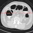 Virtual Colonography – VCU Radiology