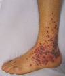 <b>Vasculitis</b> - Wikipedia