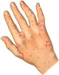 (1905) <b>scabies</b>.jpg