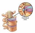 Herniated Discs