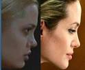 Angelina jolie plastic surgery