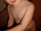 File:Erythema multiforme.jpg - Wikipedia, the free encyclopedia