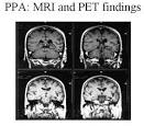 FRONTOTEMPORAL LOBE DEMENTIA