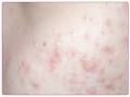 Acne Cosmetica | dermaproblems.