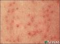 Keratosis pilaris is seen most