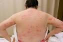 Bedbugs invade New York City Cinemas MadMikesAmerica