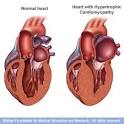 Hypertrophic cardiomyopathy