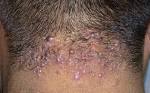 <b>Acne</b> keloidalis nuchae =العد