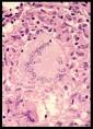 by <b>epithelioid cells</b> .