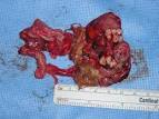 Curiosities: The Teratoma: Grossest Thing Ever