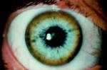 <b>Hepatolenticular Degeneration</b>