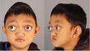 boy with Crouzon syndrome.