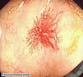<b>Angiodysplasia</b> in the caecum