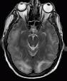 Posterior reversible encephalopathy syndrome - Wikipedia, the free ...