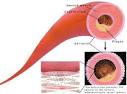 Nitroglycerin -- A Solution For The Angina Pains