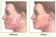 Dermabrasion - Burn Survivor Resource Center - scar healing ...