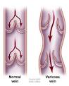 in your leg <b>veins</b> can pool