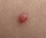File:<b>Papilloma</b> 2009 G2.jpg - Wikimedia Commons