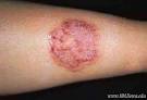 Dermatophyties - <b>Teigne</b> - Mycoses des chiens, chats, cobayes